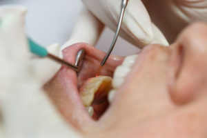 Close up of woman receiving LANAP treatment